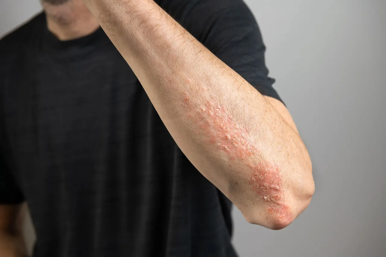 Almirall Shares Long-Term Psoriasis Study