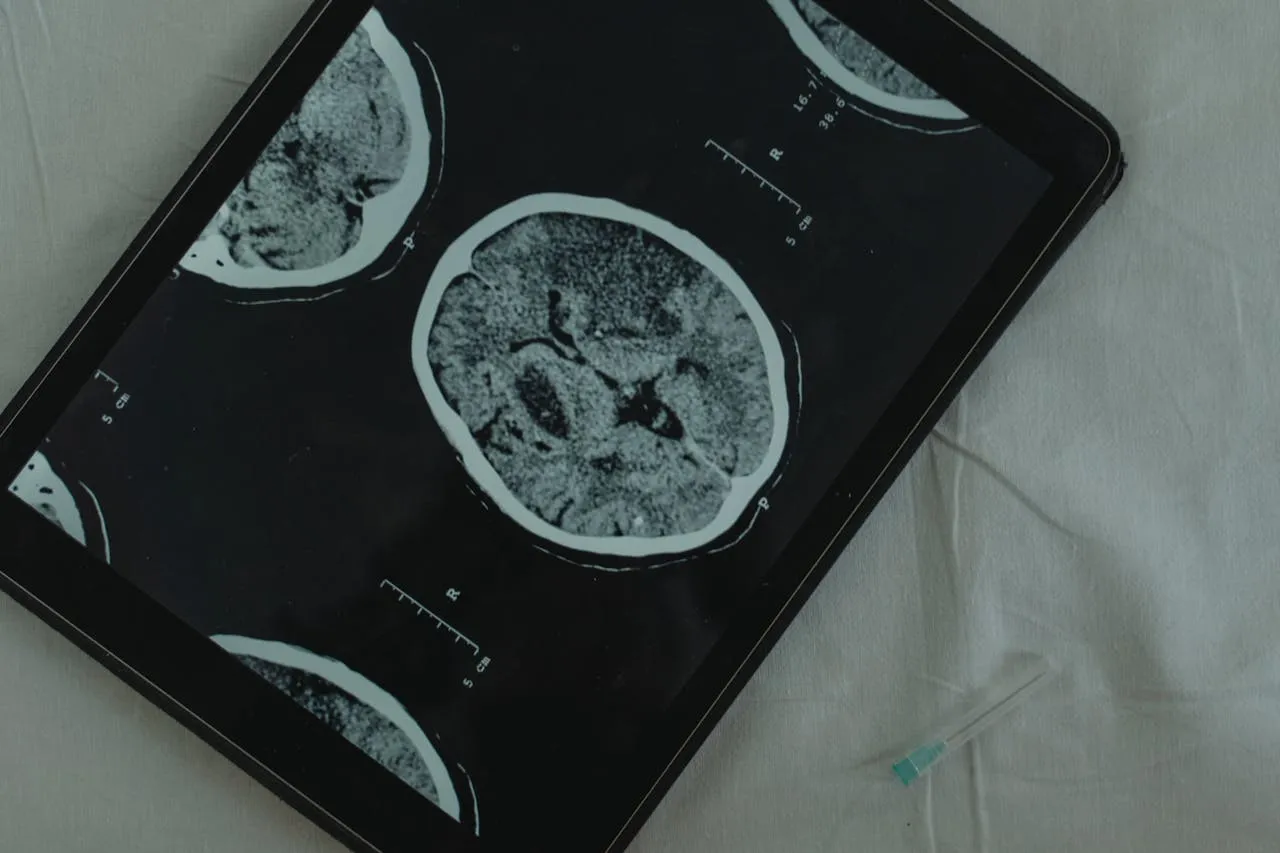 Ionis Celebrates 10 Years of Surf Away+ for Neurological Patients